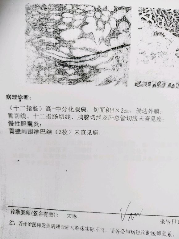 这个病理算早期还是中期。