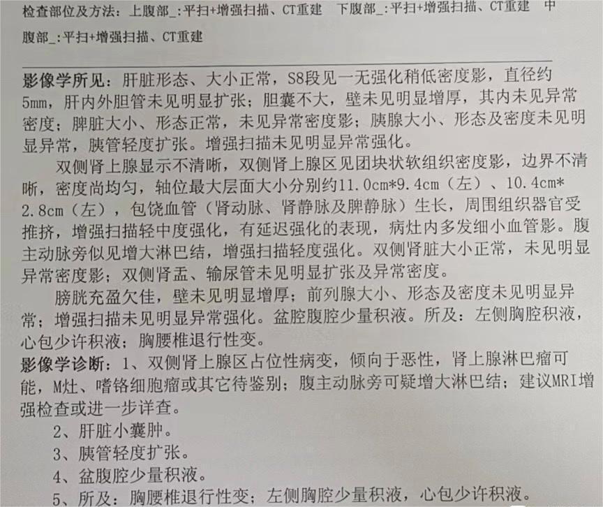 双侧肾上腺区占位性病变，倾向于恶性，肾上腺淋巴瘤